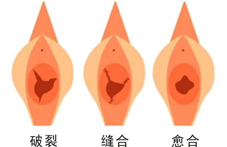 處女膜修復(fù)前后要注意事項有哪些